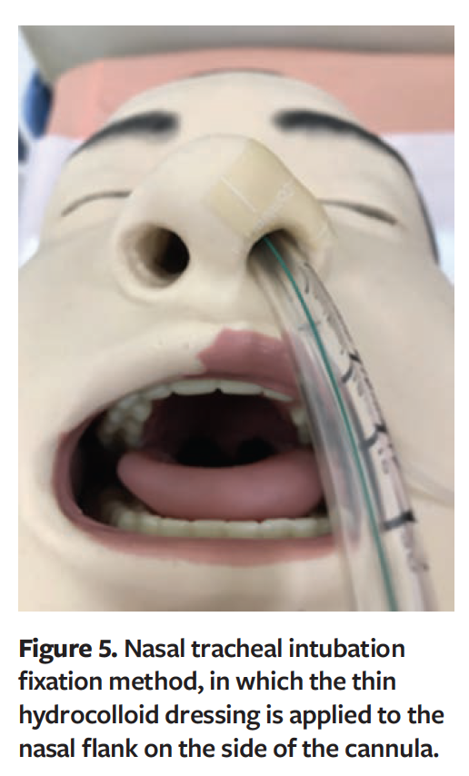 Prevention Of Hospital Acquired Transnasal Tube Related Pressure prevention-of-hospital-acquired-transnasal-tube-related-pressure